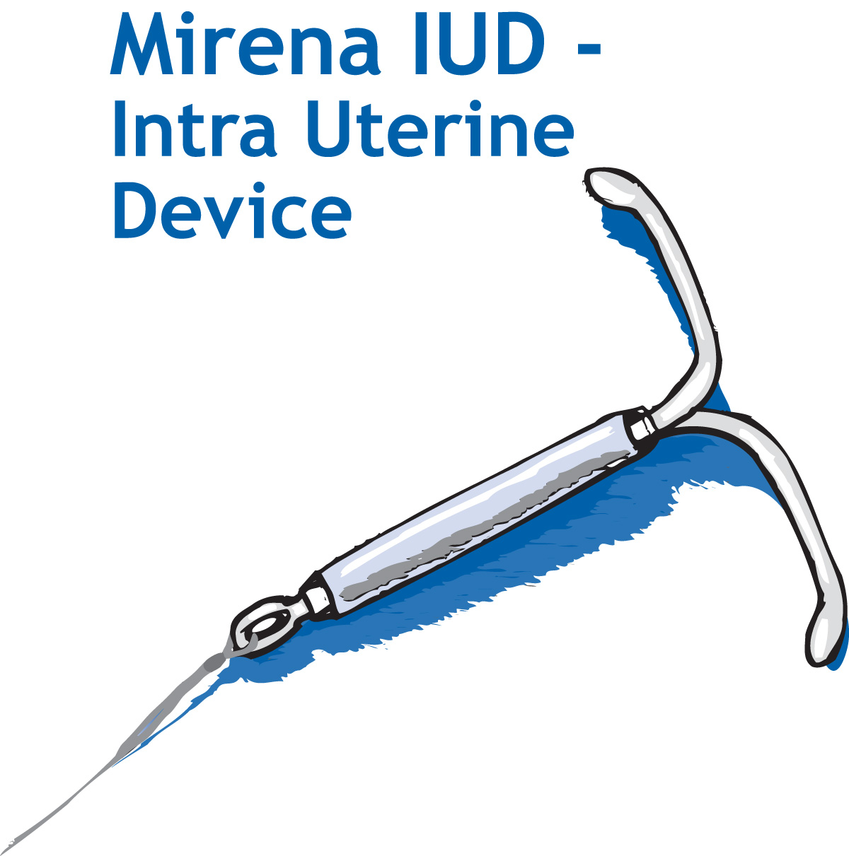 FDA Approves Mirena for Heavy Bleeding