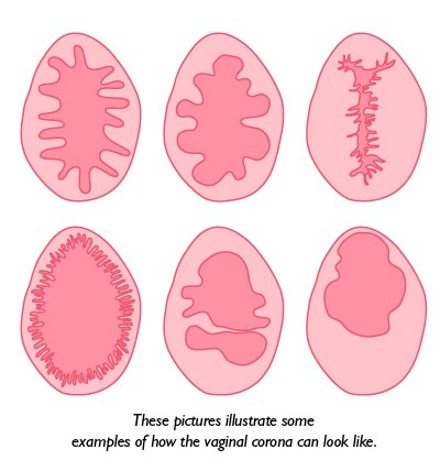 Recognizing the Vaginal Corona