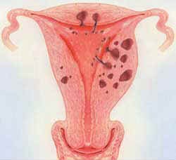 Adenomyosis: Under-diagnosed cause of pelvic pain