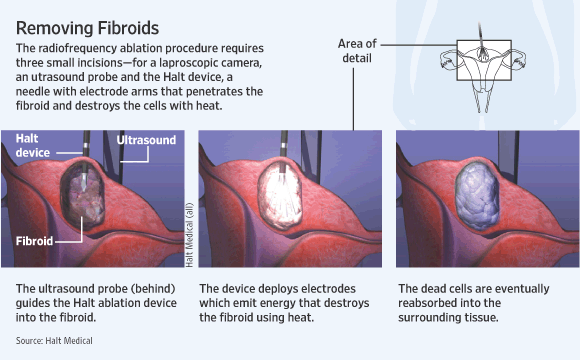 New Treatment for Uterine Fibroids