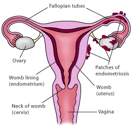 New Research Indicates Link between Early Menarche and Endometriosis