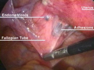 Painful Periods as Predictor of Endometriosis?